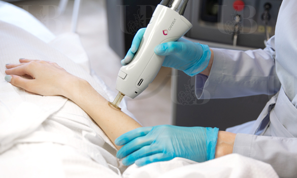 Candela Gentle Lase Pro Лазерная эпиляция