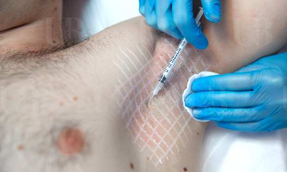 Лечение гипергидроза