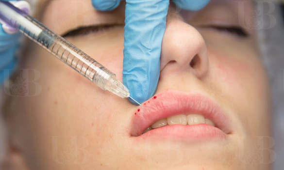 Контурная пластика губ