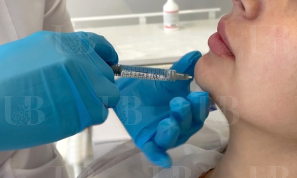 Контурная пластика подбородка